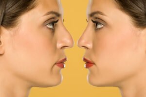before and after rhinoplasty