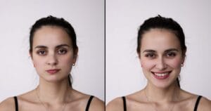 Before and after image of a young woman following rhinoplasty surgery.